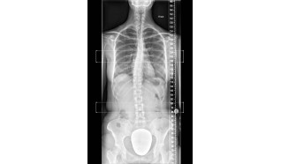 Диагностика сколиоза с помощью рентгена